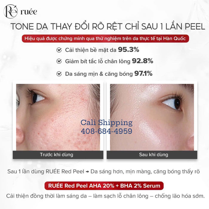 Ruee Red Peel Whitening Serum - Serum Lột Trắng Sáng Da Ruee